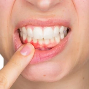 Čo je periodontitída zuba? Liečba parodontitídy mliečnych zubov