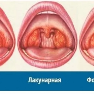 Medzera je mandľová depresia. Prevencia, liečba tonzilitídy