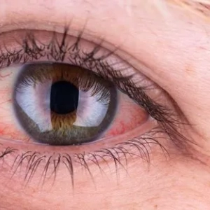 Príčina červených očí u dospelých a liečebné metódy. Zranenia a ochorenia očí